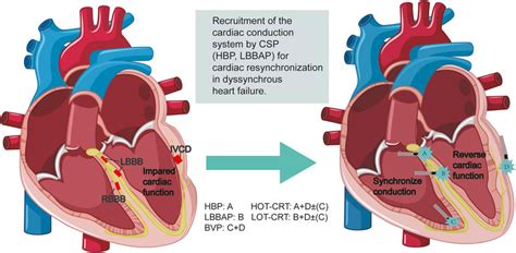 what is dyssynchronous heart failure